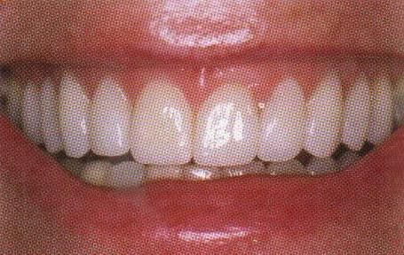 Veneers-2.jpg - large